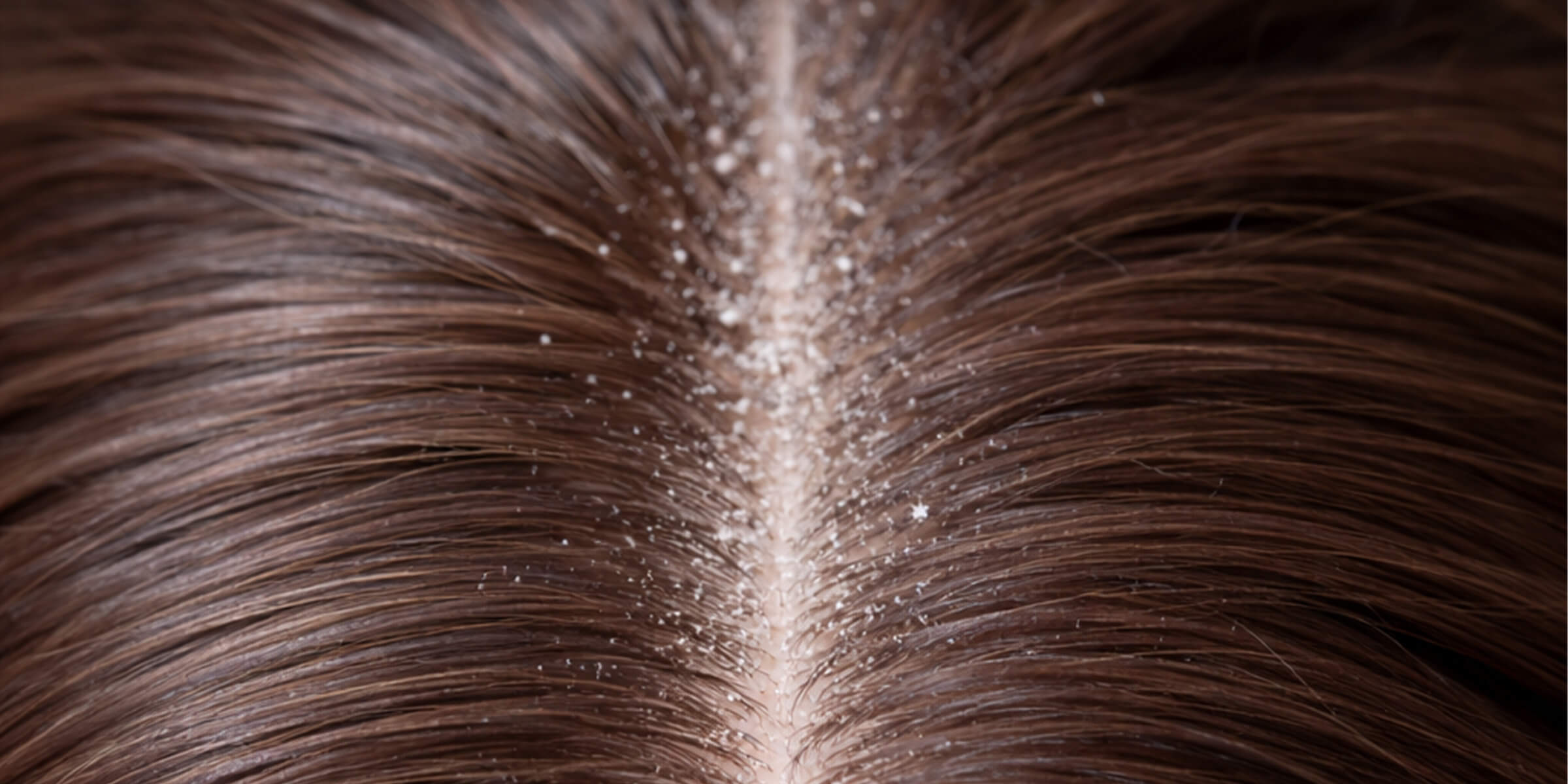 Dry scalp with visible flaking and dryness on hair roots