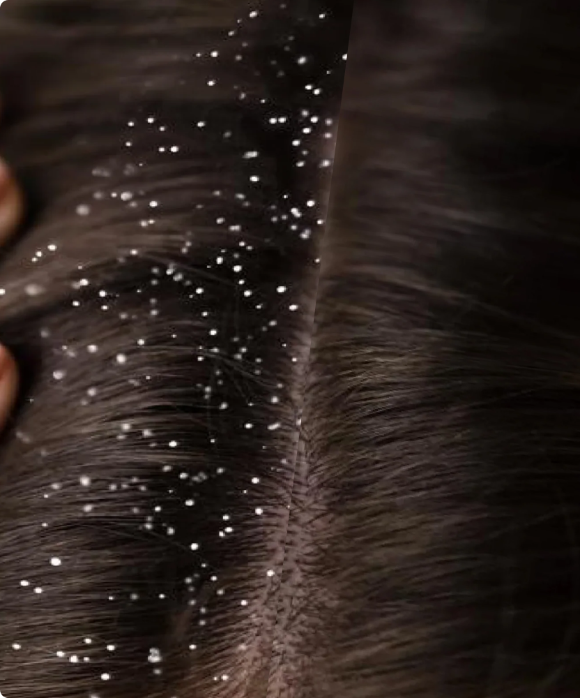 Vegan Dandruff Conditioner – Nourishing Scalp Care