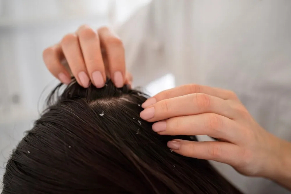 What to Use for Dry Scalp: Solutions and Recommendations You Should Try